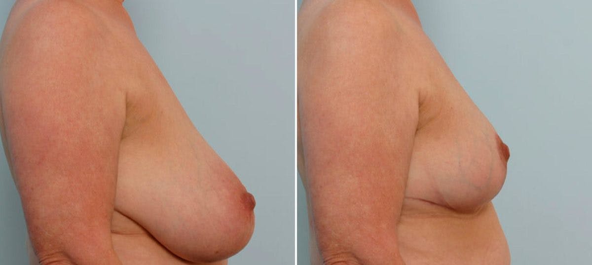 Breast Reduction Before & After Photo - Patient 55078935 - Image 3