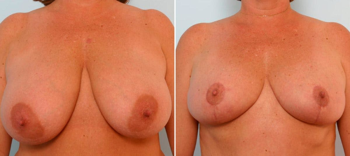 Breast Reduction Before & After Photo - Patient 55078936 - Image 1