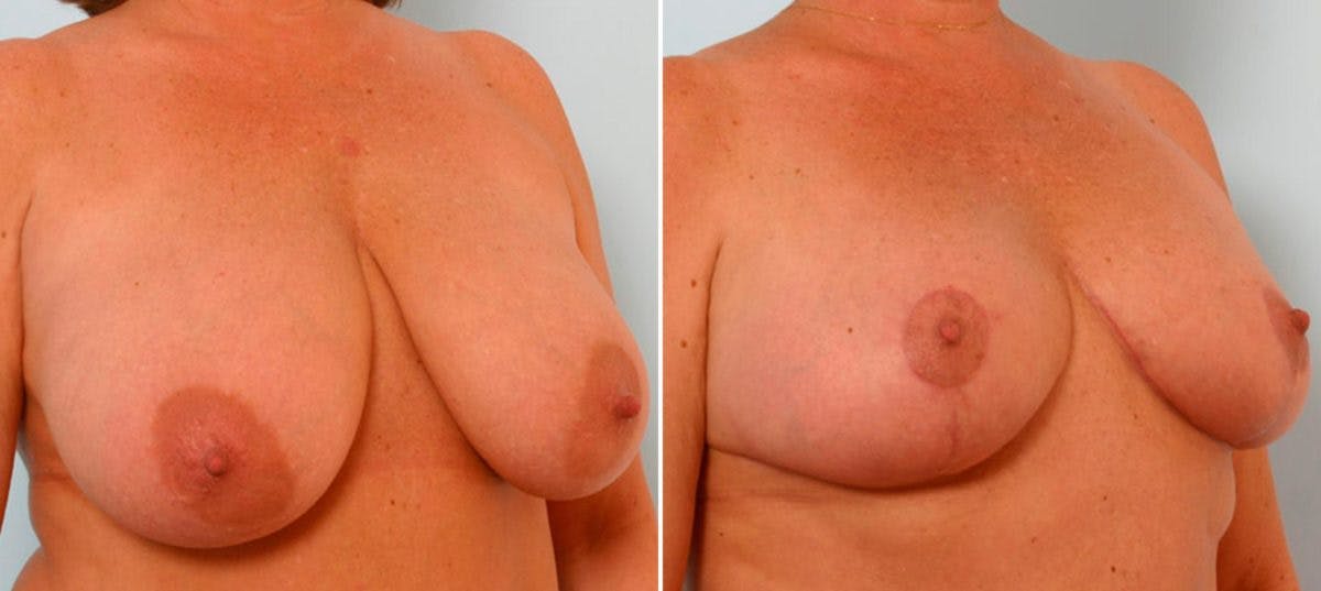 Breast Reduction Before & After Gallery - Patient 55078936 - Image 2