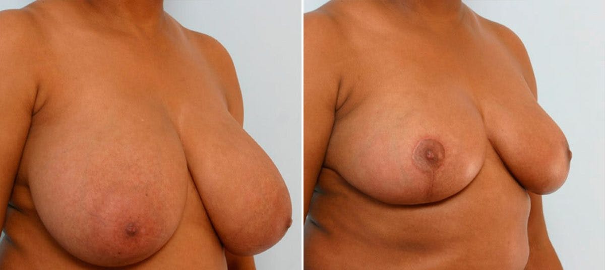 Breast Reduction Before & After Gallery - Patient 55078938 - Image 2