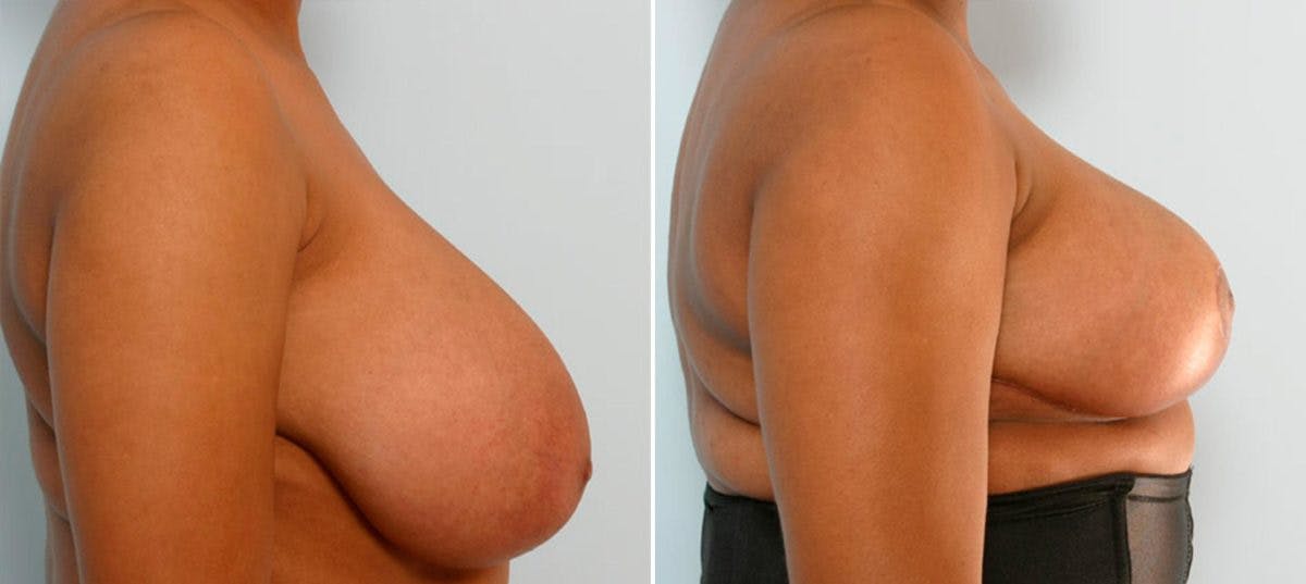 Breast Reduction Before & After Gallery - Patient 55078938 - Image 3