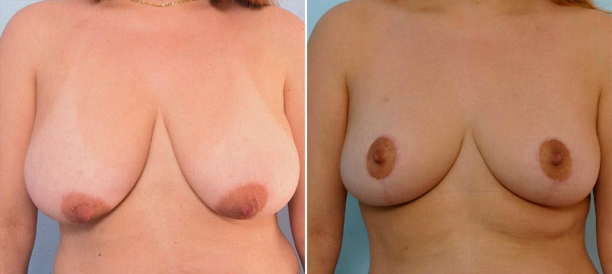 Breast Reduction Before & After Gallery - Patient 55078939 - Image 1