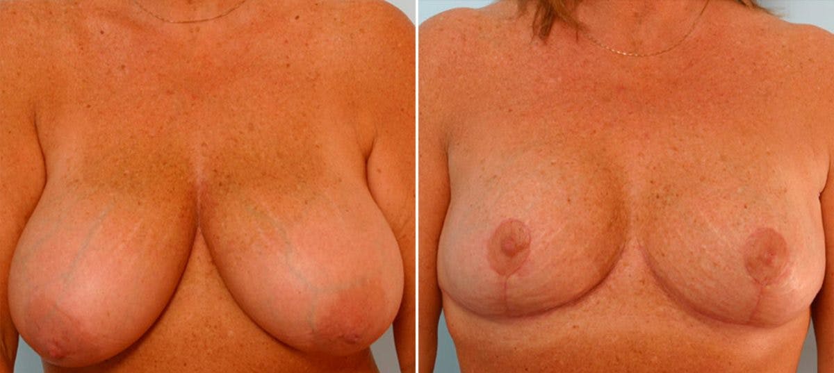 Breast Reduction Before & After Gallery - Patient 55078940 - Image 1