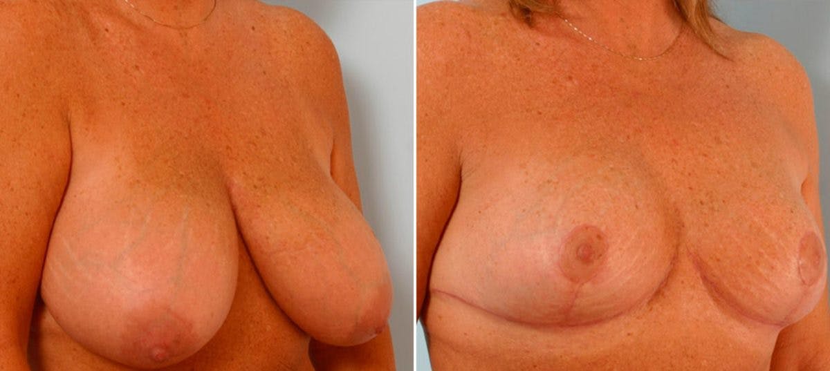 Breast Reduction Before & After Gallery - Patient 55078940 - Image 2