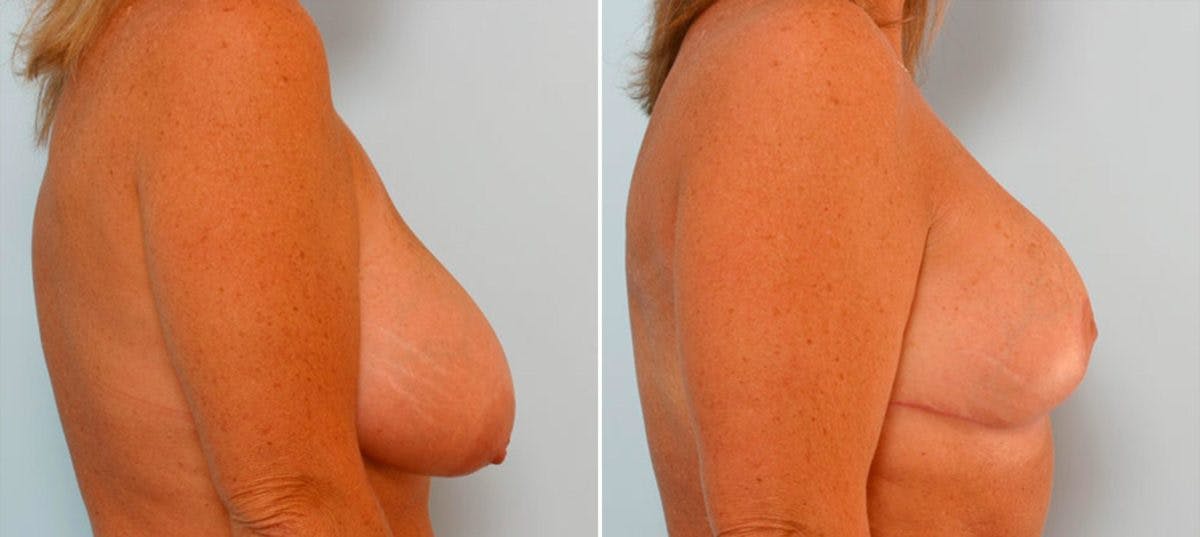 Breast Reduction Before & After Gallery - Patient 55078940 - Image 3