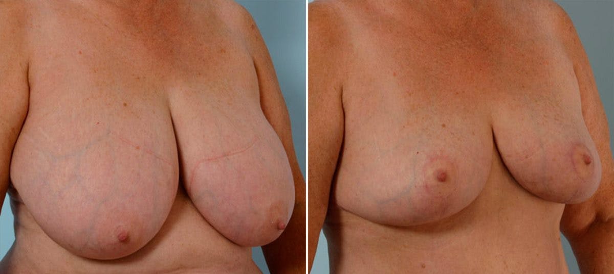 Breast Reduction Before & After Gallery - Patient 55078941 - Image 2