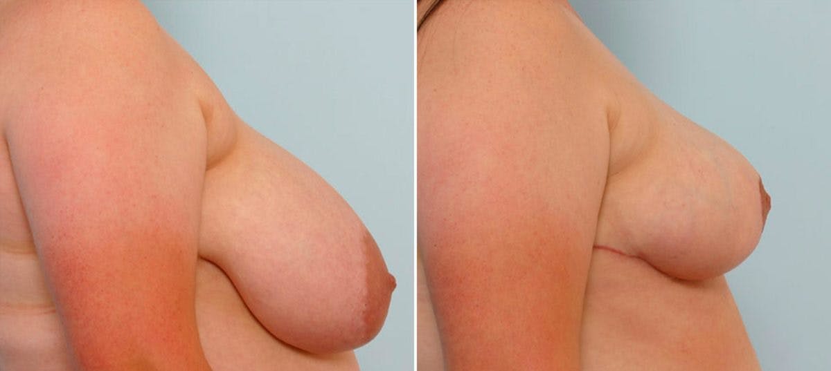 Breast Reduction Before & After Gallery - Patient 55078942 - Image 3