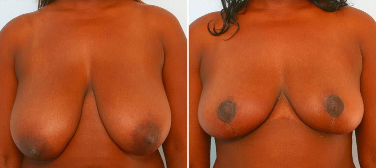 Breast Reduction Before & After Gallery - Patient 55078943 - Image 1