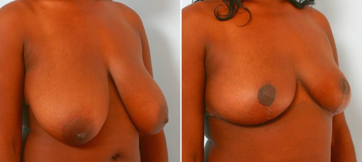 Breast Reduction Before & After Gallery - Patient 55078943 - Image 2