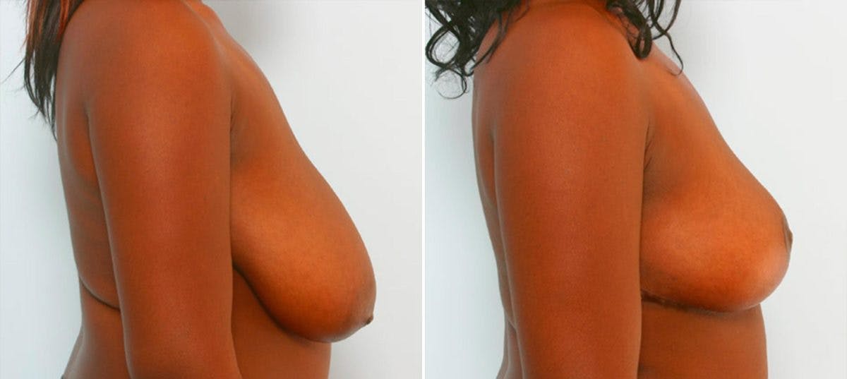 Breast Reduction Before & After Gallery - Patient 55078943 - Image 3