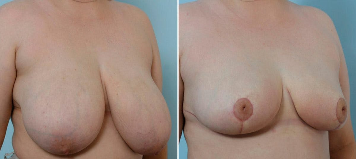 Breast Reduction Before & After Gallery - Patient 55078945 - Image 2
