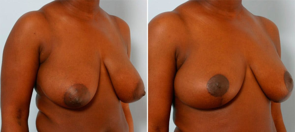 Breast Reduction Before & After Gallery - Patient 55078985 - Image 2