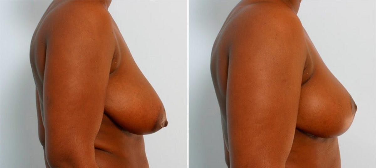 Breast Reduction Before & After Gallery - Patient 55078985 - Image 3