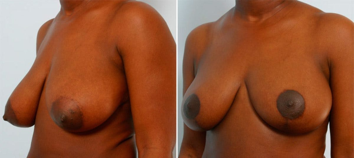 Breast Reduction Before & After Gallery - Patient 55078985 - Image 4