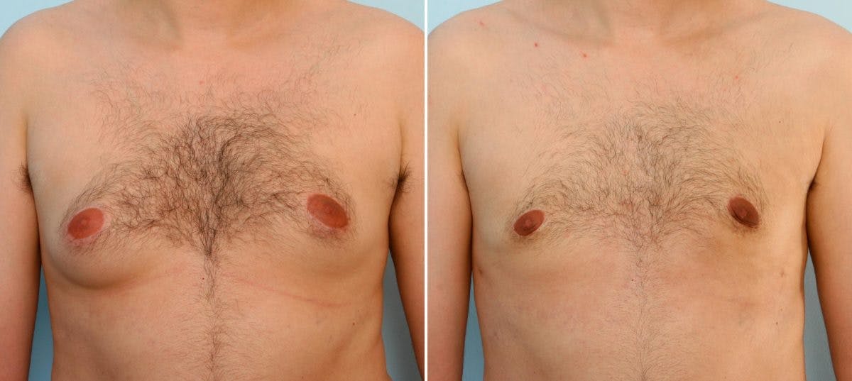 Gynecomastia (Male Breast Reduction) Before & After Gallery - Patient 55081270 - Image 1
