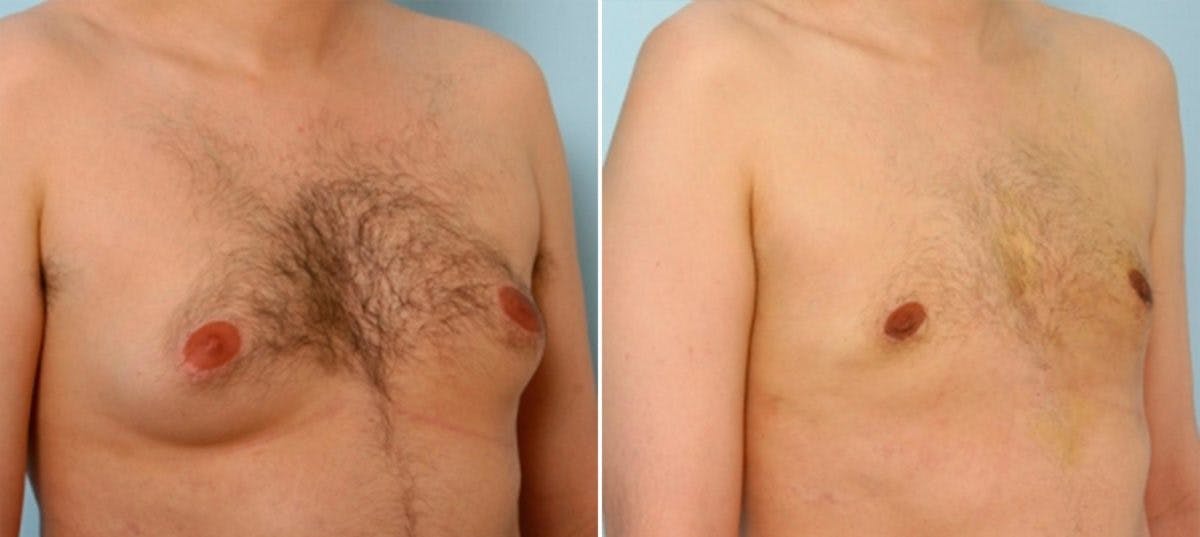 Gynecomastia (Male Breast Reduction) Before & After Gallery - Patient 55081270 - Image 2
