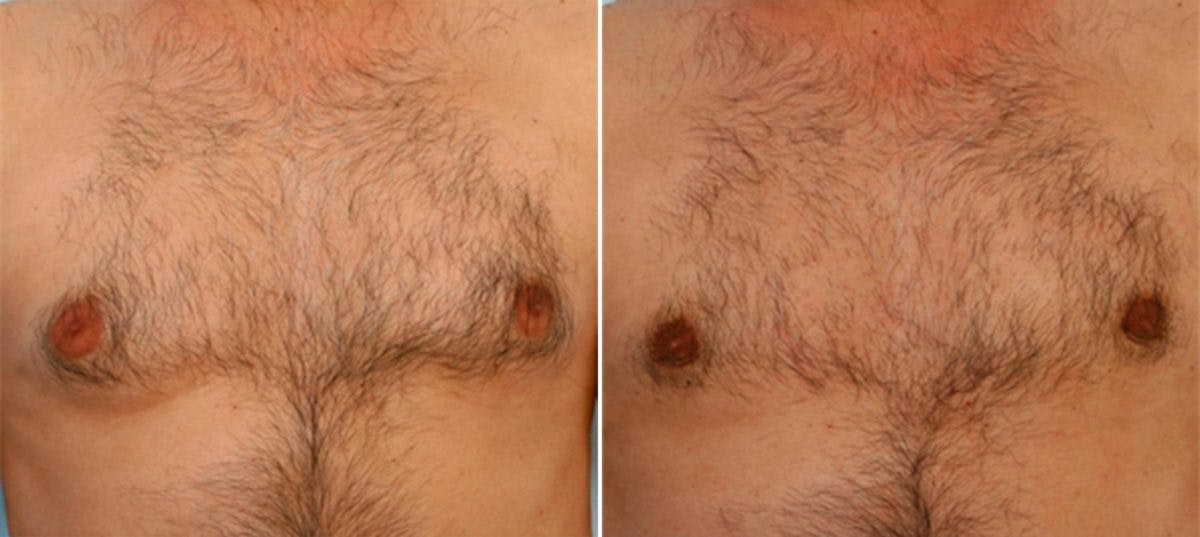 Gynecomastia (Male Breast Reduction) Before & After Gallery - Patient 55081271 - Image 1