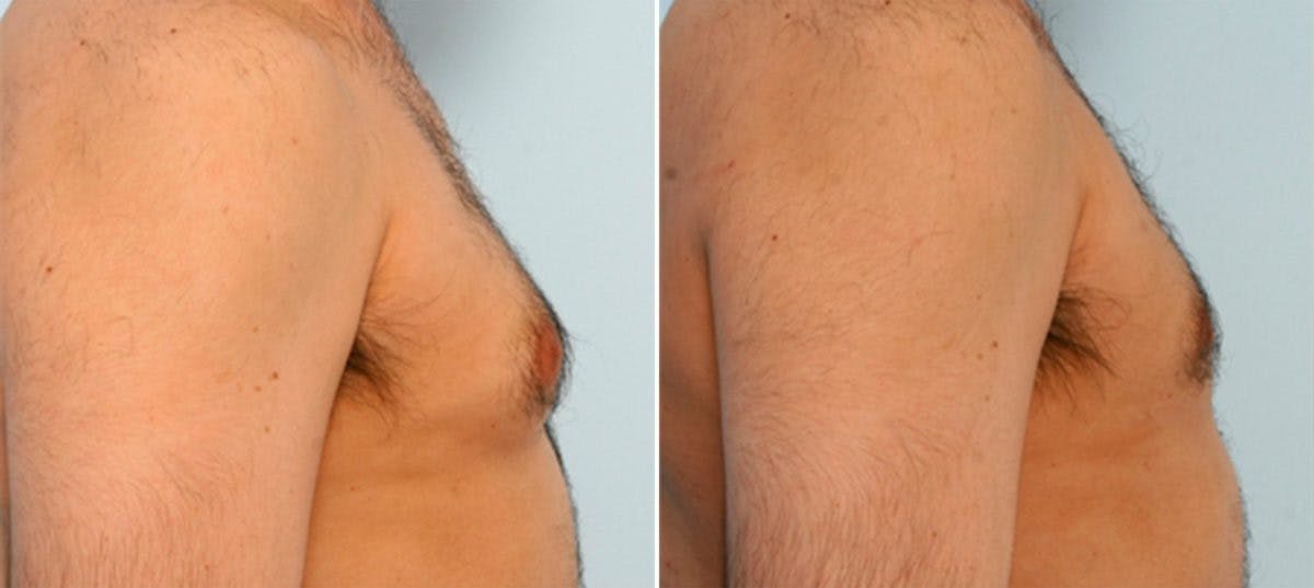 Gynecomastia (Male Breast Reduction) Before & After Photo - Patient 55081271 - Image 2