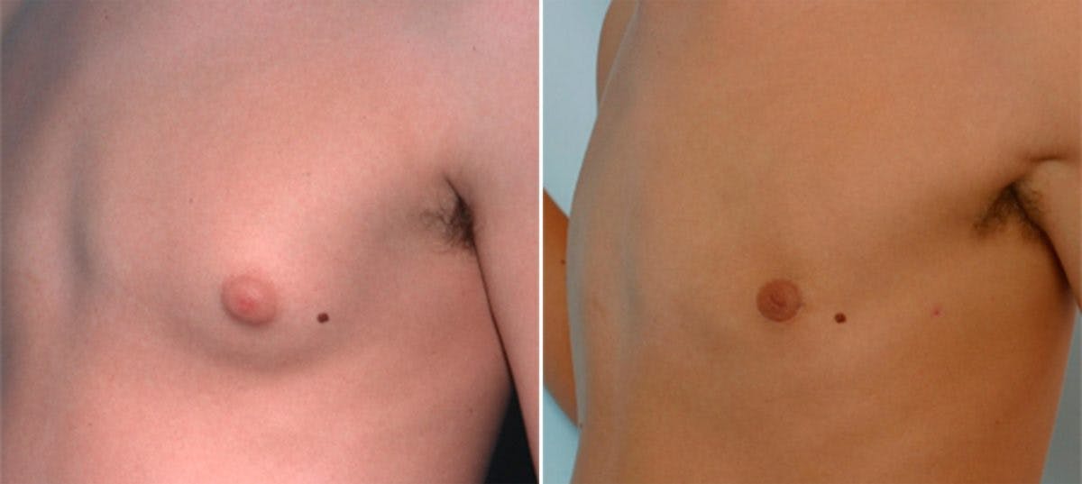 Gynecomastia (Male Breast Reduction) Before & After Gallery - Patient 55081273 - Image 2