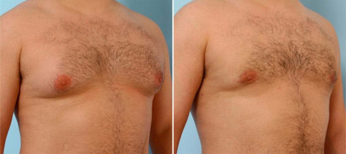 Gynecomastia (Male Breast Reduction) Before & After Gallery - Patient 55081275 - Image 2