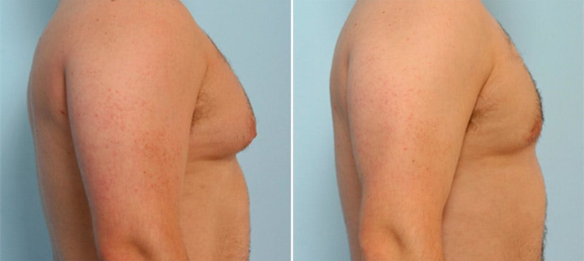 Gynecomastia (Male Breast Reduction) Before & After Gallery - Patient 55081275 - Image 3
