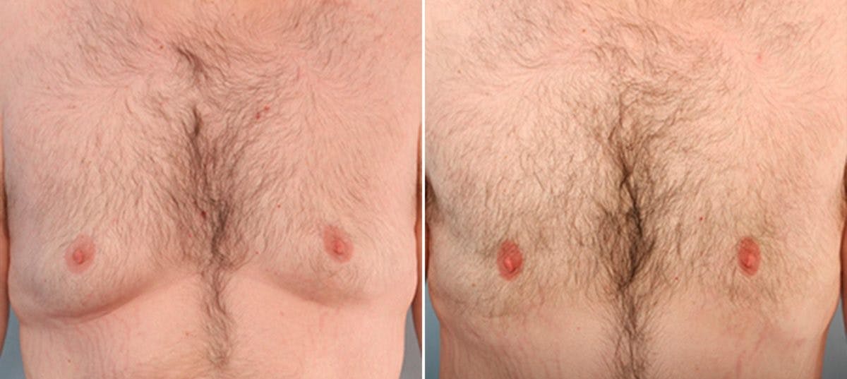 Gynecomastia (Male Breast Reduction) Before & After Gallery - Patient 55081277 - Image 1