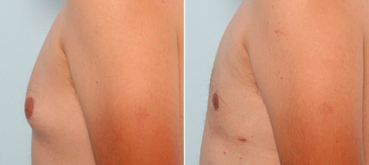 Gynecomastia (Male Breast Reduction) Before & After Gallery - Patient 55081279 - Image 2