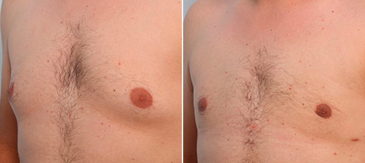 Gynecomastia (Male Breast Reduction) Before & After Gallery - Patient 55081279 - Image 3