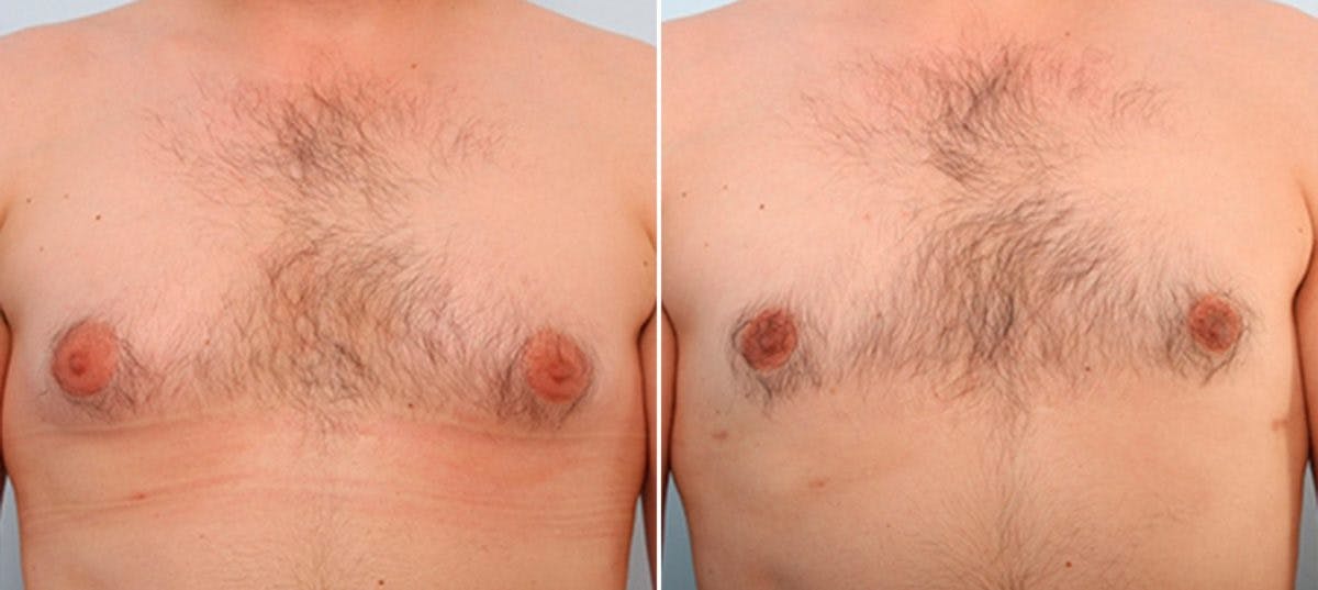 Gynecomastia (Male Breast Reduction) Before & After Gallery - Patient 55081280 - Image 1
