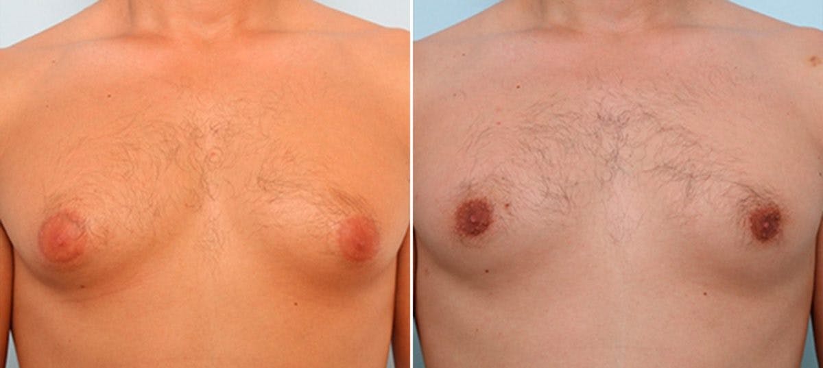 Gynecomastia (Male Breast Reduction) Before & After Gallery - Patient 55081321 - Image 1