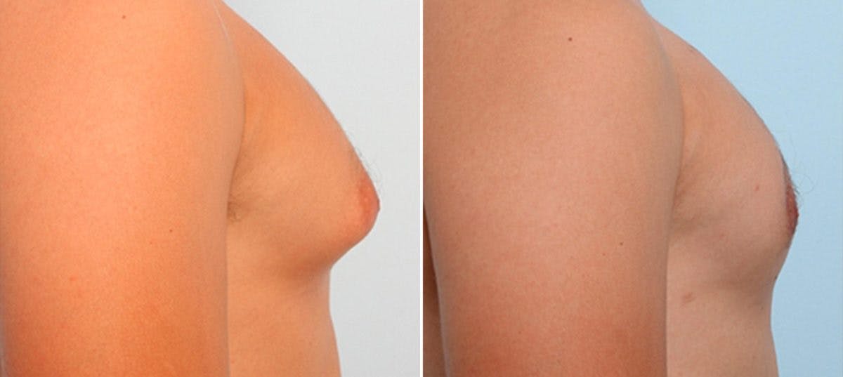 Gynecomastia (Male Breast Reduction) Before & After Gallery - Patient 55081321 - Image 2