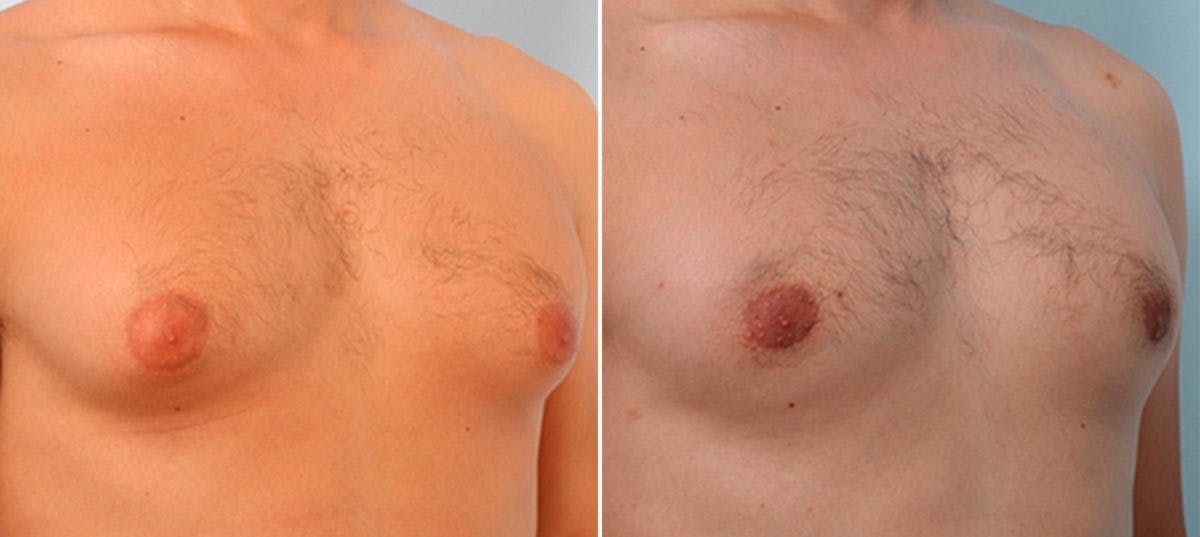 Gynecomastia (Male Breast Reduction) Before & After Gallery - Patient 55081321 - Image 3
