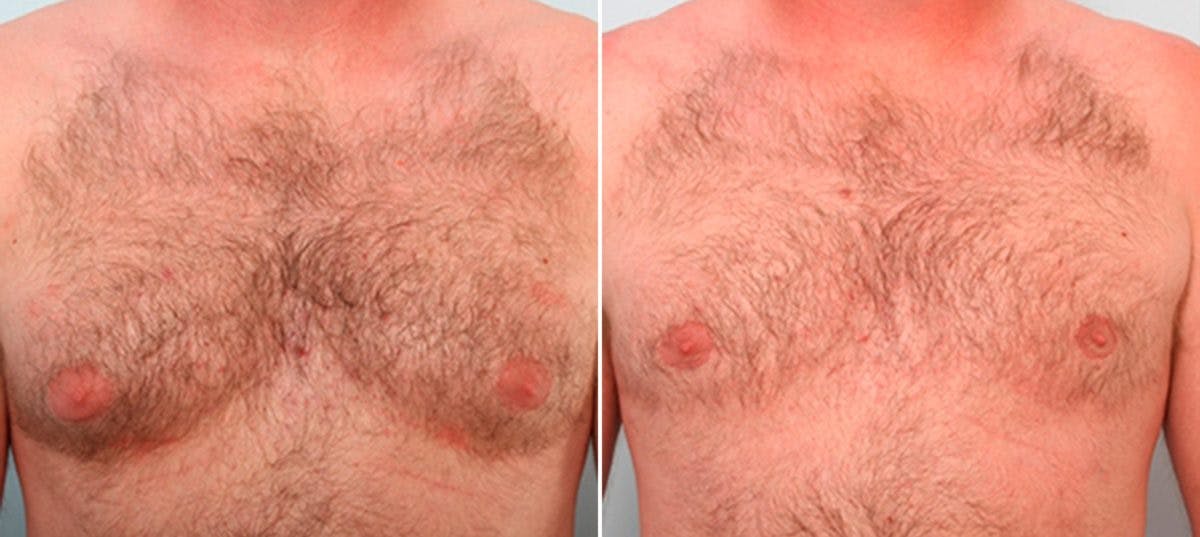 Gynecomastia (Male Breast Reduction) Before & After Gallery - Patient 55081323 - Image 1