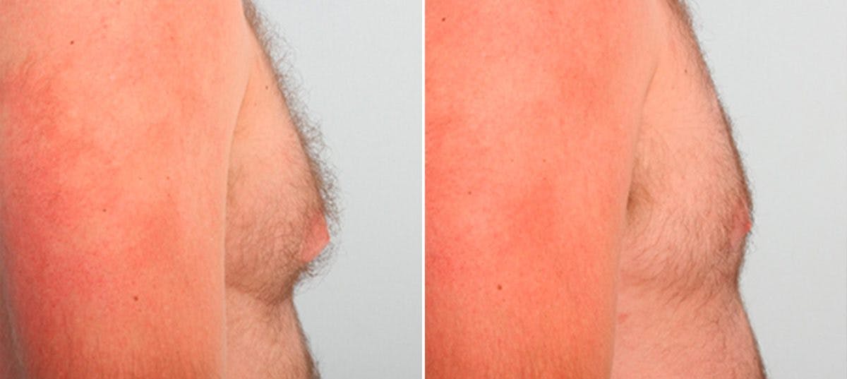 Gynecomastia (Male Breast Reduction) Before & After Gallery - Patient 55081323 - Image 2
