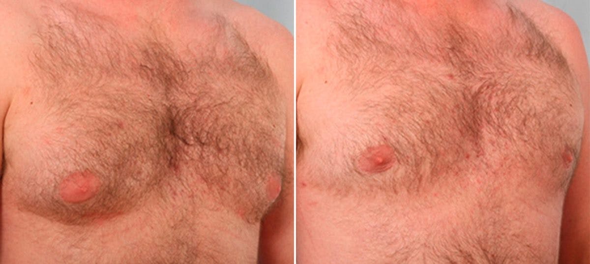 Gynecomastia (Male Breast Reduction) Before & After Gallery - Patient 55081323 - Image 3