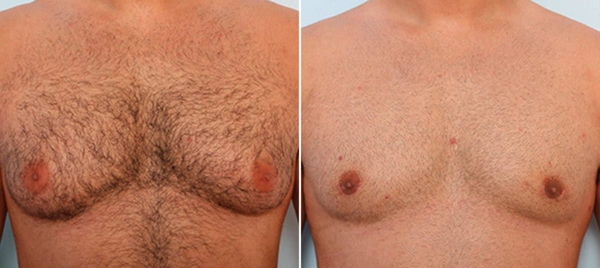 Gynecomastia (Male Breast Reduction) Before & After Gallery - Patient 55081324 - Image 1
