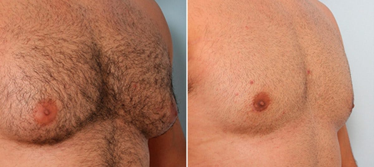 Gynecomastia (Male Breast Reduction) Before & After Gallery - Patient 55081324 - Image 3