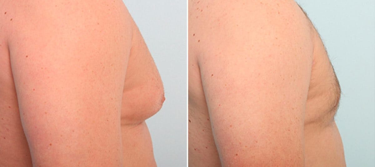 Gynecomastia (Male Breast Reduction) Before & After Gallery - Patient 55081325 - Image 2