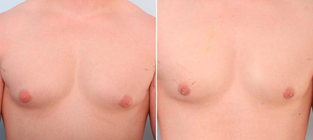 Gynecomastia (Male Breast Reduction) Before & After Gallery - Patient 55081327 - Image 1