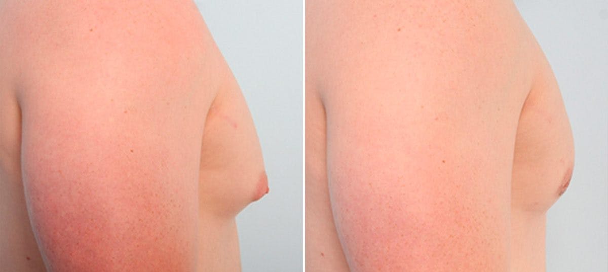 Gynecomastia (Male Breast Reduction) Before & After Gallery - Patient 55081327 - Image 2