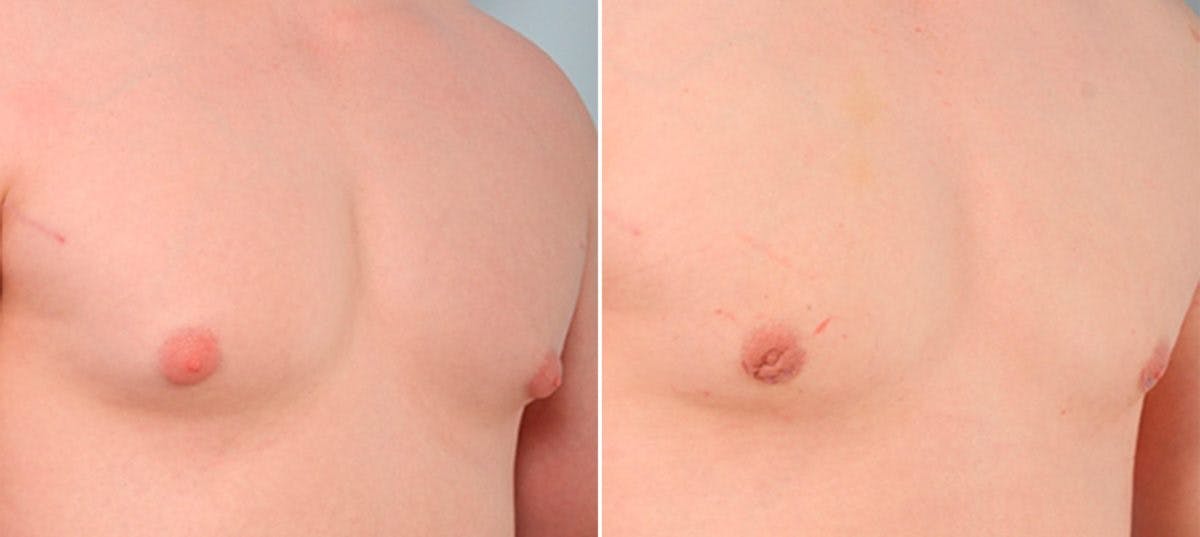 Gynecomastia (Male Breast Reduction) Before & After Gallery - Patient 55081327 - Image 3