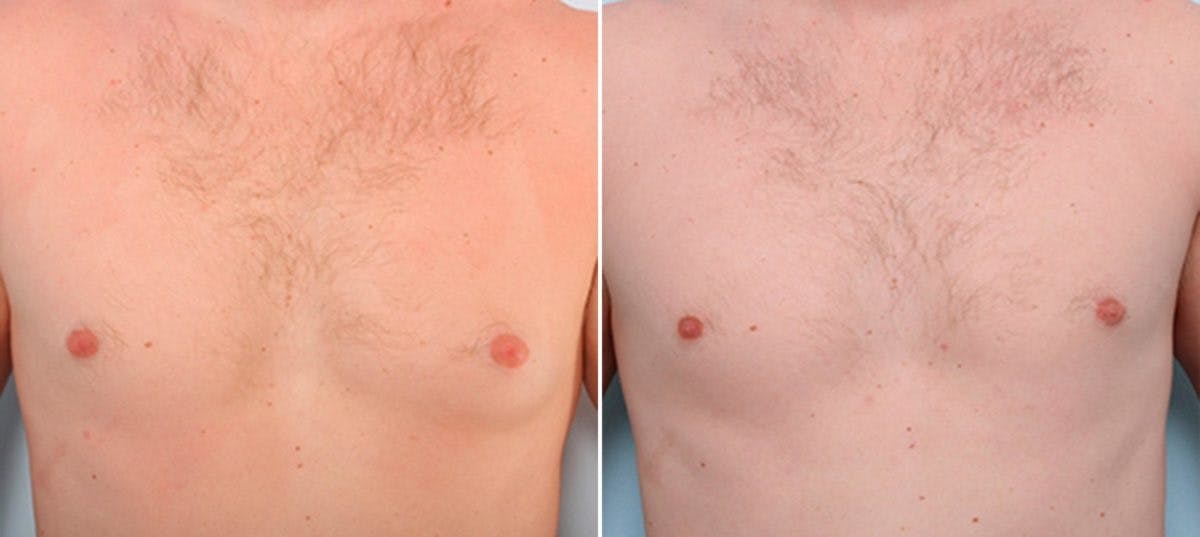 Gynecomastia (Male Breast Reduction) Before & After Gallery - Patient 55081328 - Image 1