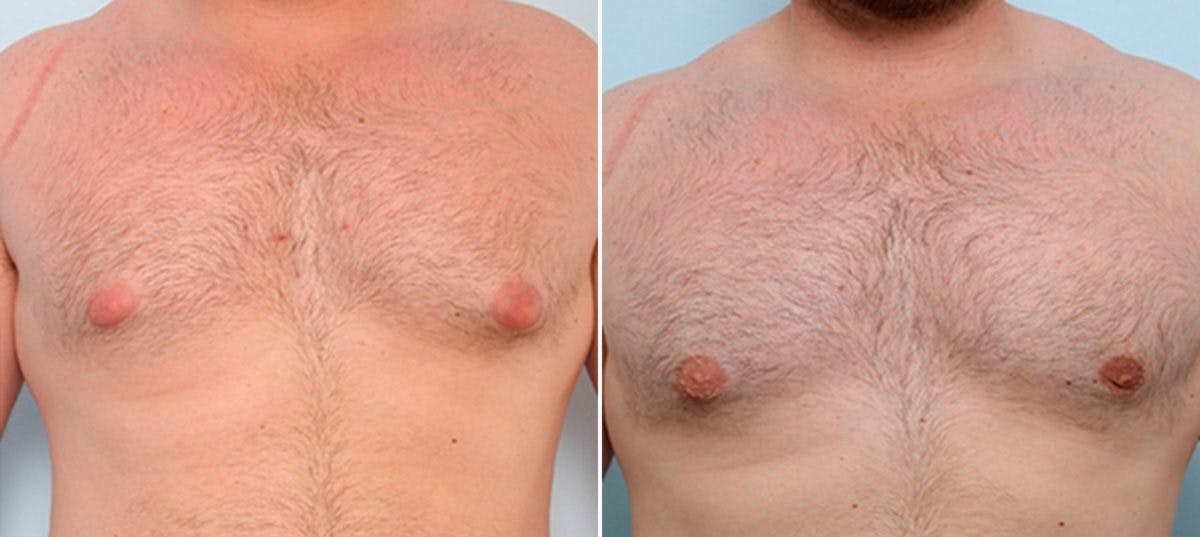 Gynecomastia (Male Breast Reduction) Before & After Gallery - Patient 55082383 - Image 1