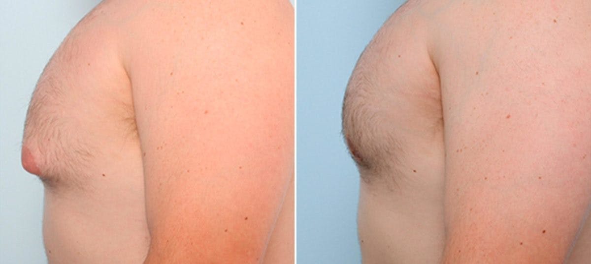 Gynecomastia (Male Breast Reduction) Before & After Gallery - Patient 55082383 - Image 2