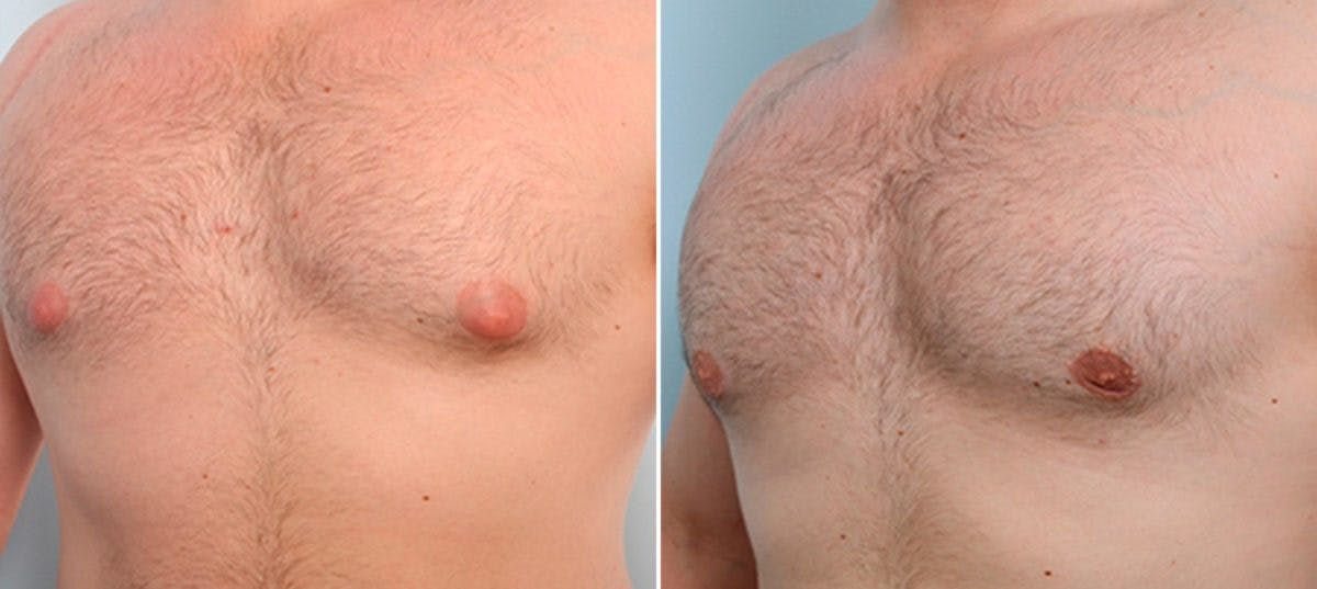 Gynecomastia (Male Breast Reduction) Before & After Gallery - Patient 55082383 - Image 3