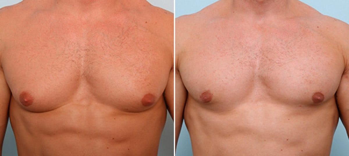 Gynecomastia (Male Breast Reduction) Before & After Gallery - Patient 55082386 - Image 1