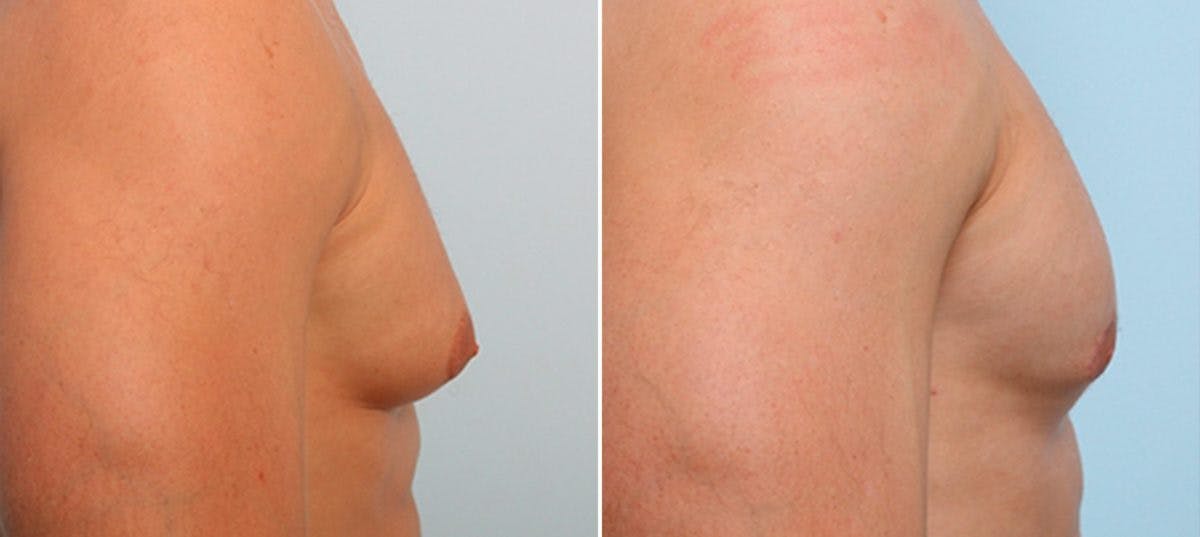 Gynecomastia (Male Breast Reduction) Before & After Gallery - Patient 55082386 - Image 2