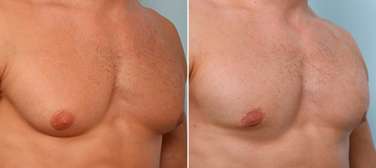 Gynecomastia (Male Breast Reduction) Before & After Gallery - Patient 55082386 - Image 3