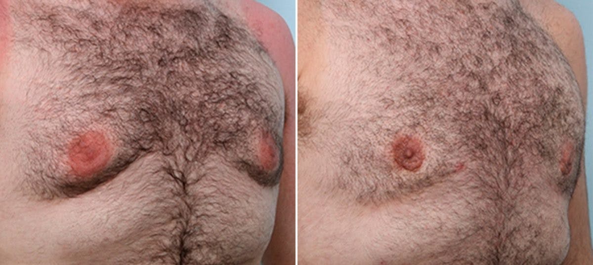 Gynecomastia (Male Breast Reduction) Before & After Gallery - Patient 55082389 - Image 3