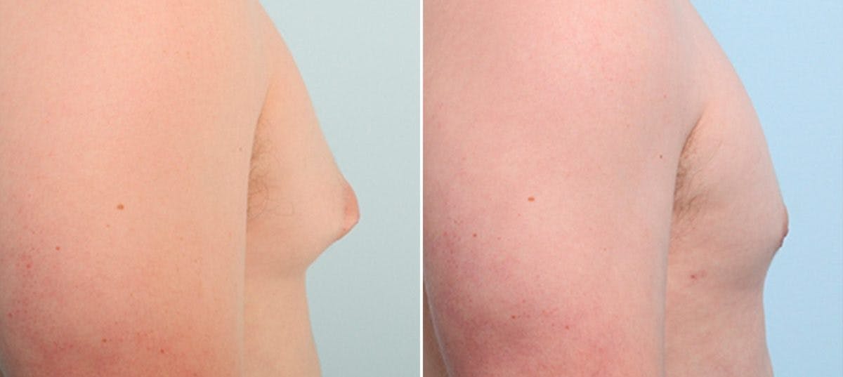 Gynecomastia (Male Breast Reduction) Before & After Gallery - Patient 55082391 - Image 2